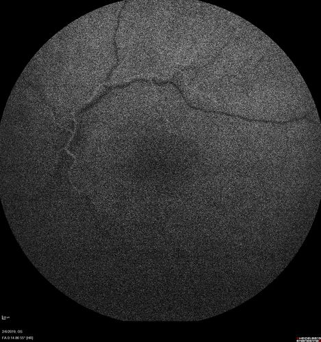 Chronic Endophthalmitis and Cystoid Macular Edema
VA 20/50 - Culture negative. Cleared with intravitreal antibiotics and decadron
