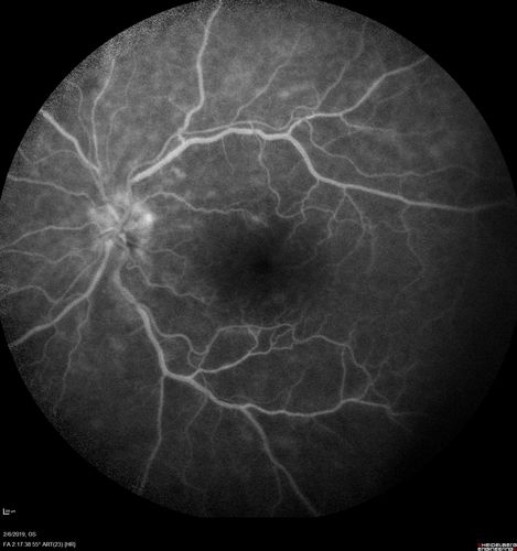 Chronic Endophthalmitis and Cystoid Macular Edema
VA 20/50 - Culture negative. Cleared with intravitreal antibiotics and decadron
