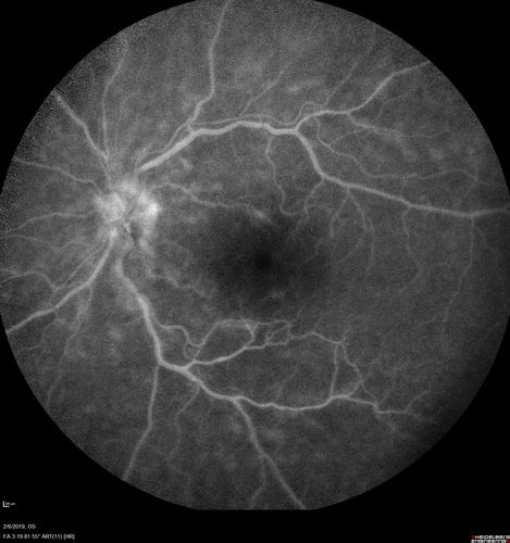 Chronic Endophthalmitis and Cystoid Macular Edema
VA 20/50 - Culture negative. Cleared with intravitreal antibiotics and decadron
