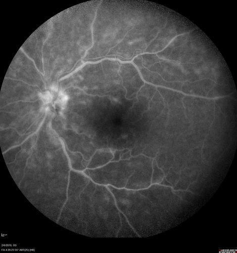 Chronic Endophthalmitis and Cystoid Macular Edema
VA 20/50 - Culture negative. Cleared with intravitreal antibiotics and decadron
