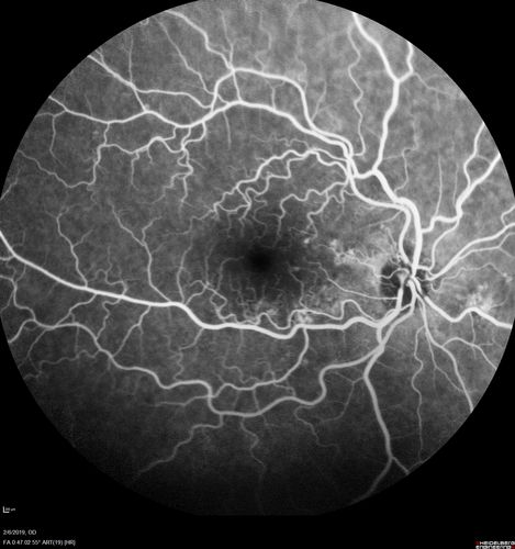 Chronic Endophthalmitis and Cystoid Macular Edema
VA 20/50 - Culture negative. Cleared with intravitreal antibiotics and decadron
