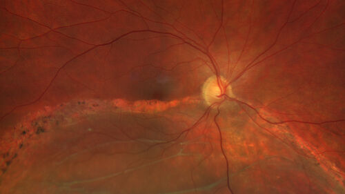 Chronic macula-splitting demarcated retinal detachment
35 year old female with 20/25 vision and noticing something wrong with the superior vision in the right eye for a long time.
