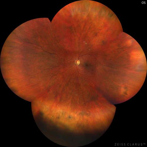 Chronic macula-splitting demarcated retinal detachment
35 year old female with 20/25 vision and noticing something wrong with the superior vision in the right eye for a long time.
