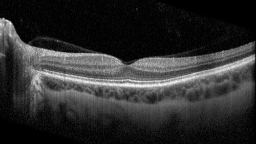 Chronic macula-splitting demarcated retinal detachment
35 year old female with 20/25 vision and noticing something wrong with the superior vision in the right eye for a long time.
