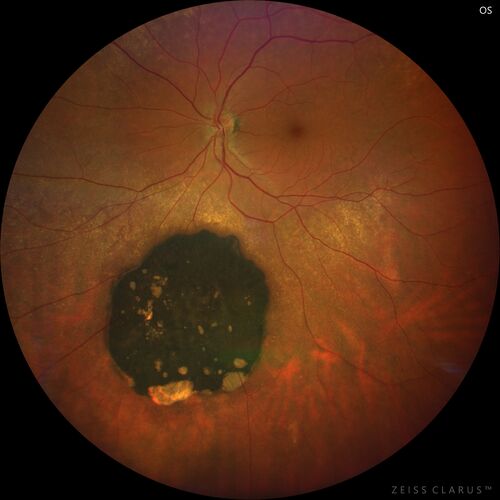 Congenital Hypertrophy of the Retinal Pigment Epithelium - CHRPE
62 year old female with CHRPE lesion. 
