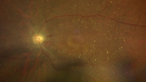 Ocular lymphoma - better following intravitreal methotrexate
VA improved from LP to 20/200 after 4 injections of methotrexate
