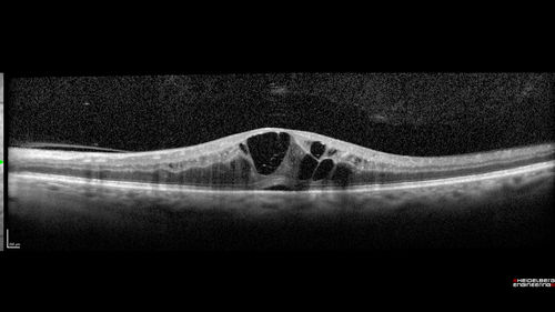 Diabetic Macular Edema - One eye treated with Eylea and 2 weeks later both were improved
68 year old female with diabetic retinopathy and macular edema   
VA OD: sc20/40 PH20/32
VA OS: sc20/40 PH20/32
IOP: TP: OD:14 OS:14 Time:12:45
