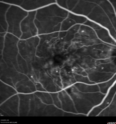 Diabetic Macular Edema - One eye treated with Eylea and 2 weeks later both were improved
68 year old female with diabetic retinopathy and macular edema   
VA OD: sc20/40 PH20/32
VA OS: sc20/40 PH20/32
IOP: TP: OD:14 OS:14 Time:12:45
