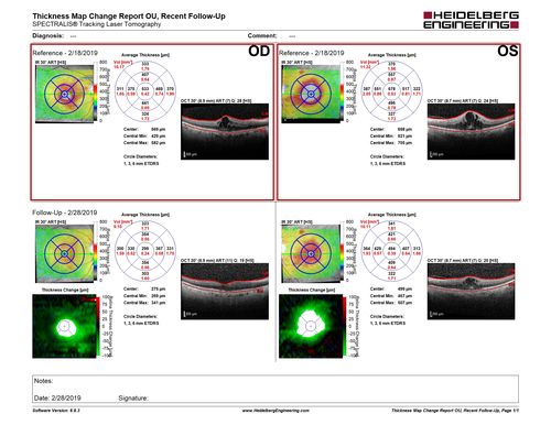Diabetic Macular Edema - One eye treated with Eylea and 2 weeks later both were improved
68 year old female with diabetic retinopathy and macular edema   
VA OD: sc20/40 PH20/32
VA OS: sc20/40 PH20/32
IOP: TP: OD:14 OS:14 Time:12:45

