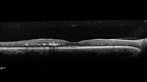 Macular ischemia left eye in type I diabetic (enlarged foveal avascular zone)
29 year old female with type I diabetes since age 5.  Left eye has enlarged FAZ with vision of 20/20 OD and 20/60 OS.  Both eyes have CSME.  The left eye did have focal laser
