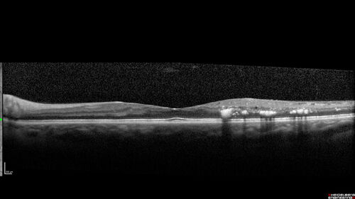 Macular ischemia left eye in type I diabetic (enlarged foveal avascular zone)
29 year old female with type I diabetes since age 5.  Left eye has enlarged FAZ with vision of 20/20 OD and 20/60 OS.  Both eyes have CSME.  The left eye did have focal laser
