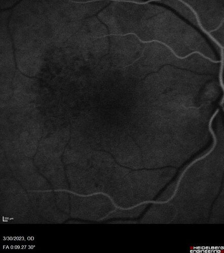 Macular ischemia left eye in type I diabetic (enlarged foveal avascular zone)
29 year old female with type I diabetes since age 5.  Left eye has enlarged FAZ with vision of 20/20 OD and 20/60 OS.  Both eyes have CSME.  The left eye did have focal laser
