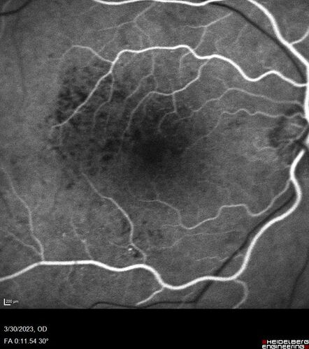 Macular ischemia left eye in type I diabetic (enlarged foveal avascular zone)
29 year old female with type I diabetes since age 5.  Left eye has enlarged FAZ with vision of 20/20 OD and 20/60 OS.  Both eyes have CSME.  The left eye did have focal laser
