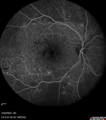 Macular ischemia left eye in type I diabetic (enlarged foveal avascular zone)
29 year old female with type I diabetes since age 5.  Left eye has enlarged FAZ with vision of 20/20 OD and 20/60 OS.  Both eyes have CSME.  The left eye did have focal laser
