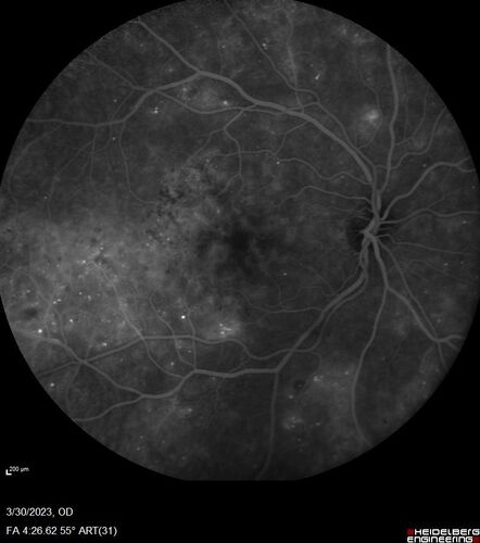 Macular ischemia left eye in type I diabetic (enlarged foveal avascular zone)
29 year old female with type I diabetes since age 5.  Left eye has enlarged FAZ with vision of 20/20 OD and 20/60 OS.  Both eyes have CSME.  The left eye did have focal laser
