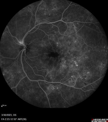 Macular ischemia left eye in type I diabetic (enlarged foveal avascular zone)
29 year old female with type I diabetes since age 5.  Left eye has enlarged FAZ with vision of 20/20 OD and 20/60 OS.  Both eyes have CSME.  The left eye did have focal laser
