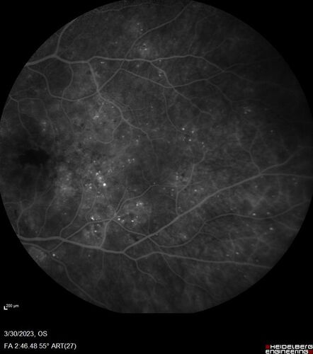 Macular ischemia left eye in type I diabetic (enlarged foveal avascular zone)
29 year old female with type I diabetes since age 5.  Left eye has enlarged FAZ with vision of 20/20 OD and 20/60 OS.  Both eyes have CSME.  The left eye did have focal laser
