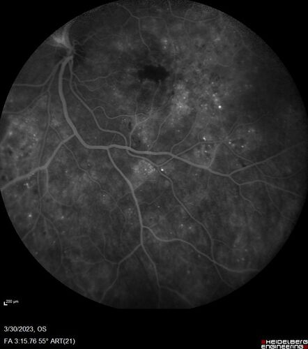 Macular ischemia left eye in type I diabetic (enlarged foveal avascular zone)
29 year old female with type I diabetes since age 5.  Left eye has enlarged FAZ with vision of 20/20 OD and 20/60 OS.  Both eyes have CSME.  The left eye did have focal laser
