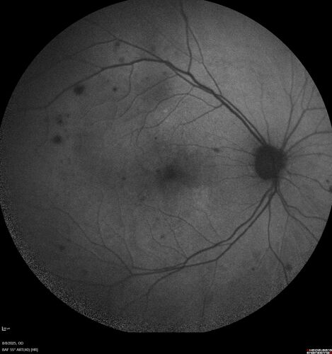 NPDR and Severe macular ischemia sudden vision loss
60 year old female with sudden vision loss OD 1 week ago.  VA 20/63, 20/200.  OCT-A and FA shows severe macular ischemia OU
