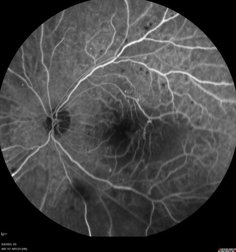 NPDR and Severe macular ischemia sudden vision loss
60 year old female with sudden vision loss OD 1 week ago.  VA 20/63, 20/200.  OCT-A and FA shows severe macular ischemia OU
