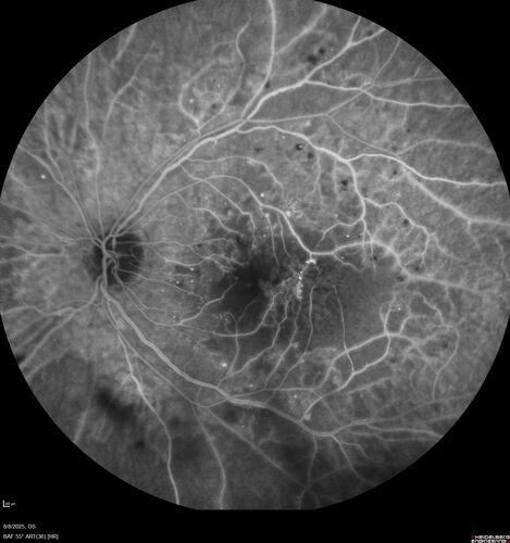 NPDR and Severe macular ischemia sudden vision loss
60 year old female with sudden vision loss OD 1 week ago.  VA 20/63, 20/200.  OCT-A and FA shows severe macular ischemia OU
