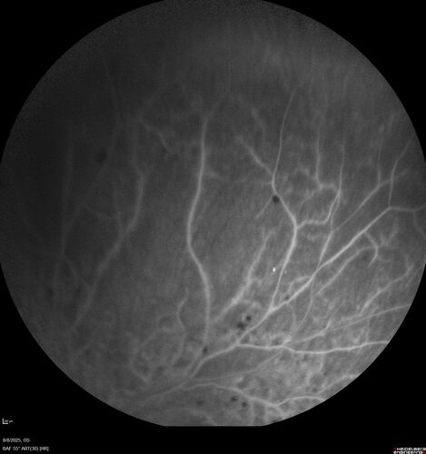 NPDR and Severe macular ischemia sudden vision loss
60 year old female with sudden vision loss OD 1 week ago.  VA 20/63, 20/200.  OCT-A and FA shows severe macular ischemia OU
