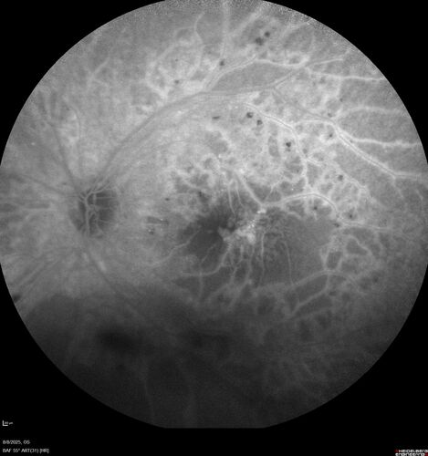 NPDR and Severe macular ischemia sudden vision loss
60 year old female with sudden vision loss OD 1 week ago.  VA 20/63, 20/200.  OCT-A and FA shows severe macular ischemia OU
