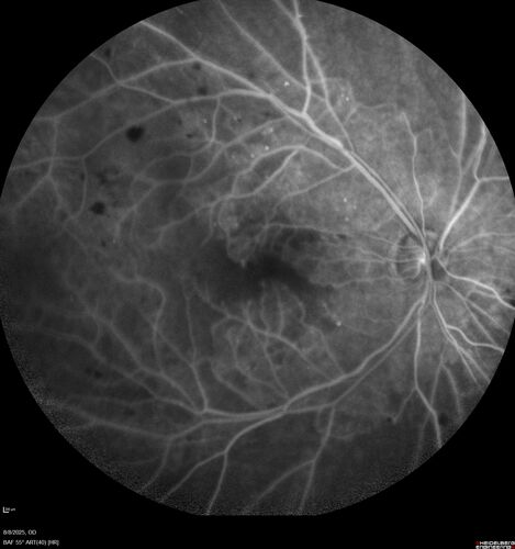 NPDR and Severe macular ischemia sudden vision loss
60 year old female with sudden vision loss OD 1 week ago.  VA 20/63, 20/200.  OCT-A and FA shows severe macular ischemia OU
