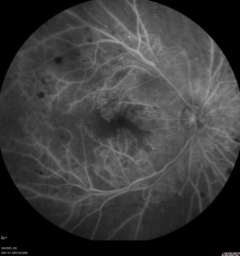 NPDR and Severe macular ischemia sudden vision loss
60 year old female with sudden vision loss OD 1 week ago.  VA 20/63, 20/200.  OCT-A and FA shows severe macular ischemia OU
