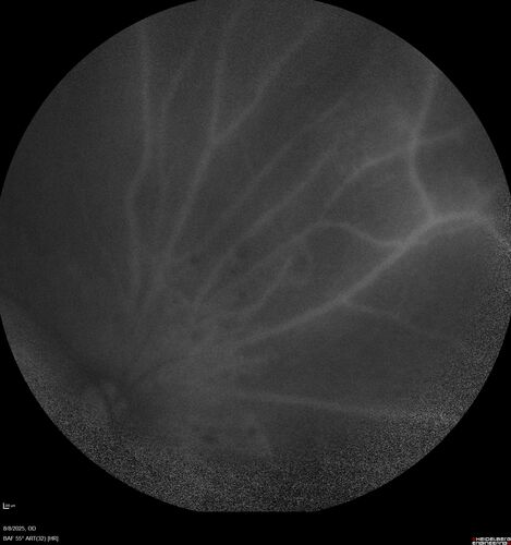 NPDR and Severe macular ischemia sudden vision loss
60 year old female with sudden vision loss OD 1 week ago.  VA 20/63, 20/200.  OCT-A and FA shows severe macular ischemia OU
