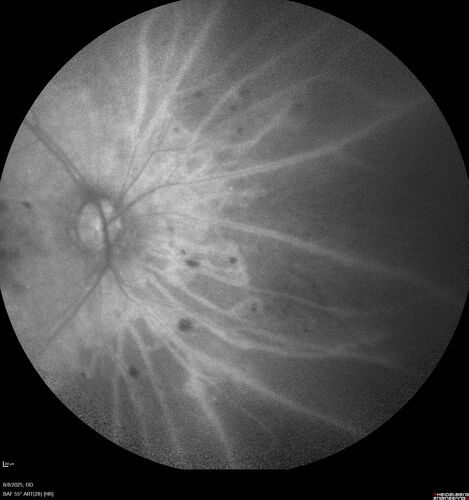 NPDR and Severe macular ischemia sudden vision loss
60 year old female with sudden vision loss OD 1 week ago.  VA 20/63, 20/200.  OCT-A and FA shows severe macular ischemia OU

