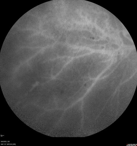 NPDR and Severe macular ischemia sudden vision loss
60 year old female with sudden vision loss OD 1 week ago.  VA 20/63, 20/200.  OCT-A and FA shows severe macular ischemia OU
