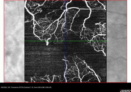 NPDR and Severe macular ischemia sudden vision loss
60 year old female with sudden vision loss OD 1 week ago.  VA 20/63, 20/200.  OCT-A and FA shows severe macular ischemia OU
