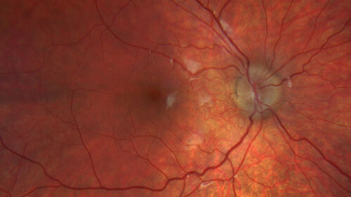 Optic Disc Drusen in a child (non Calcified)
Fluorescein angiography shows no leakage
