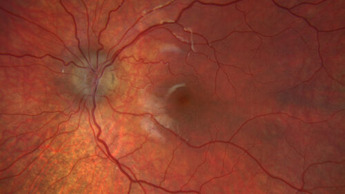 Optic Disc Drusen in a child (non Calcified)
Fluorescein angiography shows no leakage
