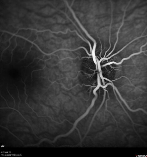 Optic Disc Drusen in a child (non Calcified)
Fluorescein angiography shows no leakage
