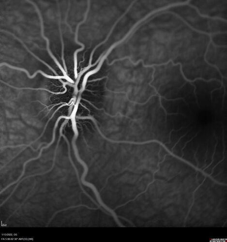 Optic Disc Drusen in a child (non Calcified)
Fluorescein angiography shows no leakage
