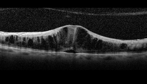 Disorganized Retinal Inner Layers (DRIL)
72 year old man treated with Avastin for CRVO VA is still 20/200 with absent macular edema (Only 1 month post rx)
