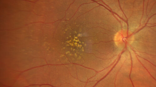 54 year old female with a lot of drusen
VA 20/12 OD, 20/16 OS - no symptoms

