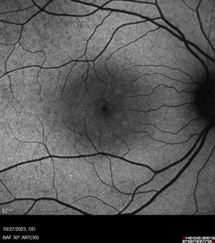 54 year old female with a lot of drusen
VA 20/12 OD, 20/16 OS - no symptoms
