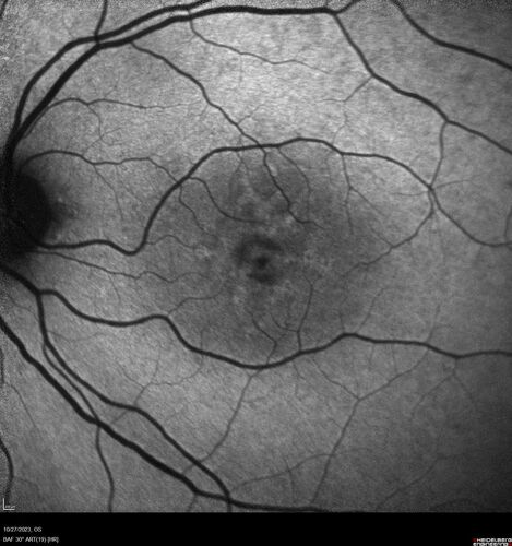 54 year old female with a lot of drusen
VA 20/12 OD, 20/16 OS - no symptoms
