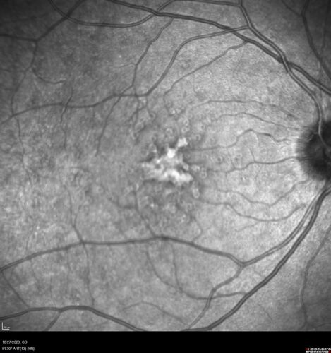 54 year old female with a lot of drusen
VA 20/12 OD, 20/16 OS - no symptoms
