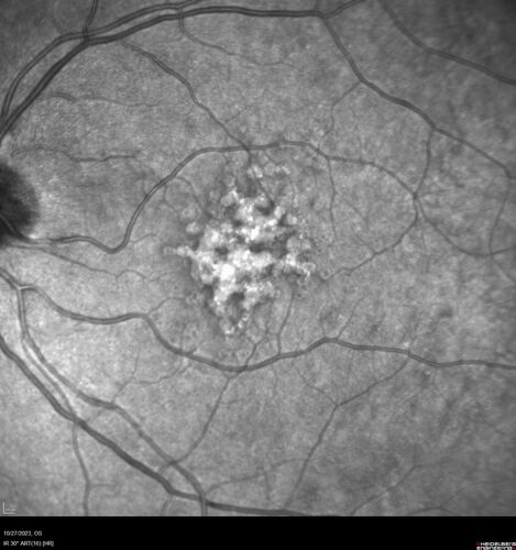54 year old female with a lot of drusen
VA 20/12 OD, 20/16 OS - no symptoms
