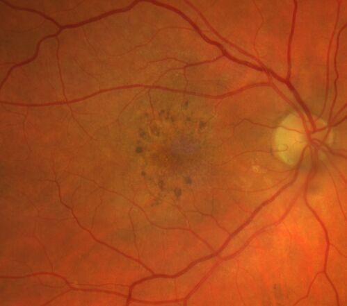 Pigment migration in dry age-related macular degeneration
80 year old female.  Dry AMD with GA in the left eye and pigment migration visible on OCT scan.
VA 20/40 OD, 20/160 OS
