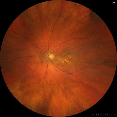 Pigment migration in dry age-related macular degeneration
80 year old female.  Dry AMD with GA in the left eye and pigment migration visible on OCT scan.
VA 20/40 OD, 20/160 OS
