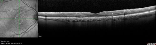 Pigment migration in dry age-related macular degeneration
80 year old female.  Dry AMD with GA in the left eye and pigment migration visible on OCT scan.
VA 20/40 OD, 20/160 OS
