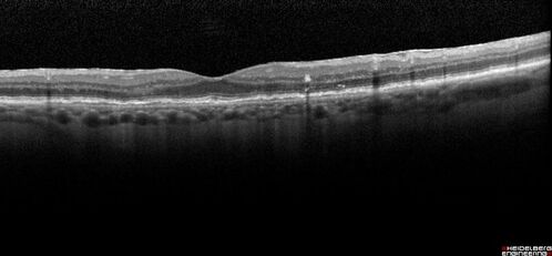 Pigment migration in dry age-related macular degeneration
80 year old female.  Dry AMD with GA in the left eye and pigment migration visible on OCT scan.
VA 20/40 OD, 20/160 OS
