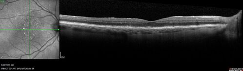 Pigment migration in dry age-related macular degeneration
80 year old female.  Dry AMD with GA in the left eye and pigment migration visible on OCT scan.
VA 20/40 OD, 20/160 OS
