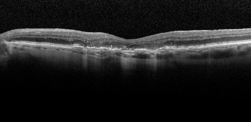Pigment migration in dry age-related macular degeneration
80 year old female.  Dry AMD with GA in the left eye and pigment migration visible on OCT scan.
VA 20/40 OD, 20/160 OS

