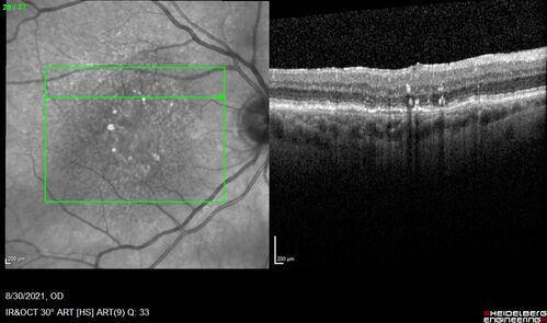 Pigment migration in dry age-related macular degeneration
80 year old female.  Dry AMD with GA in the left eye and pigment migration visible on OCT scan.
VA 20/40 OD, 20/160 OS
